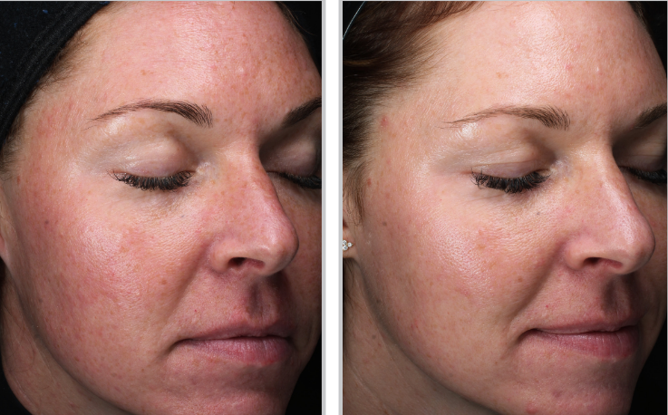 Before and after ClearSilk™ treatment showcasing reduced redness and smoother skin tone.