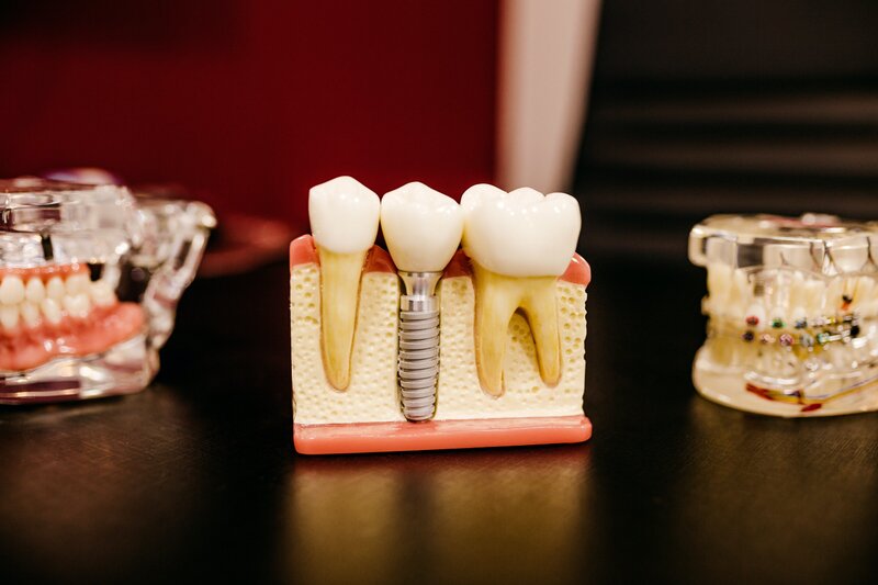 a model of implants sits on a desk