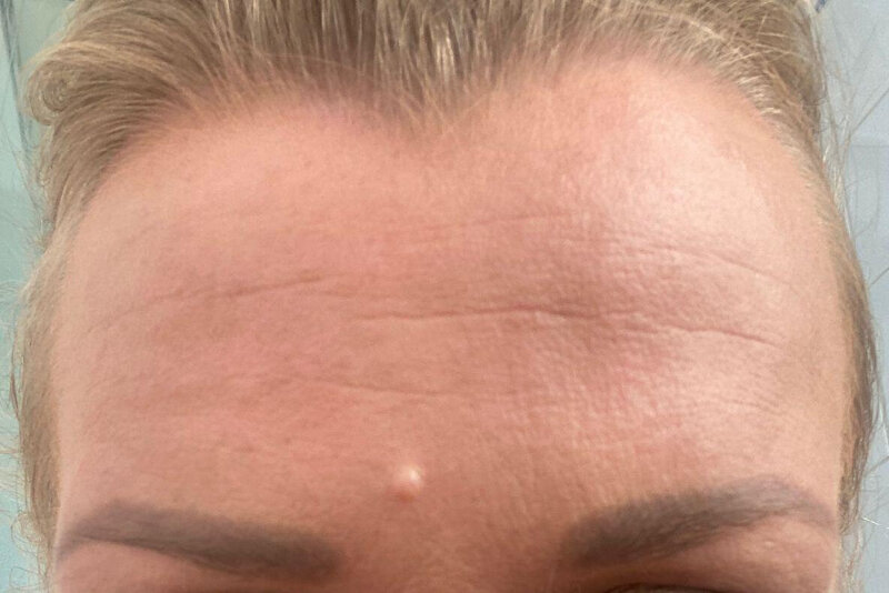carbonpeel soins esthétique
