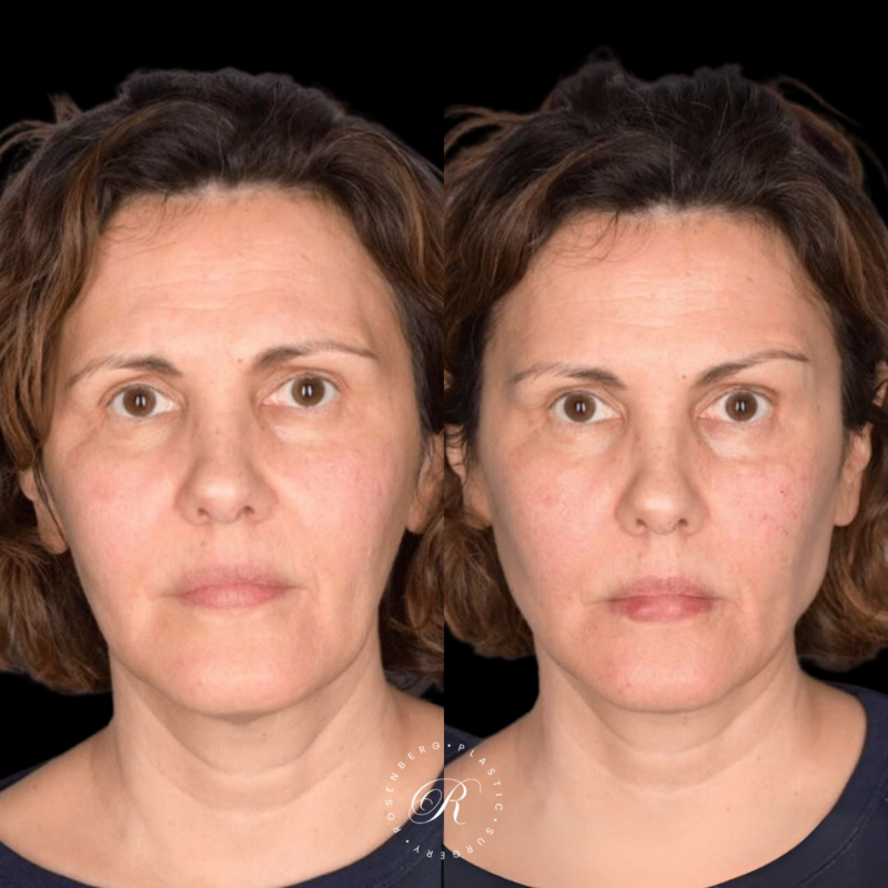Non-surgical Cheek Augmentation RPS Before & After.zip - 2