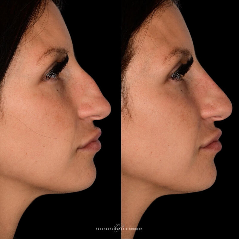 Nose Filler Results