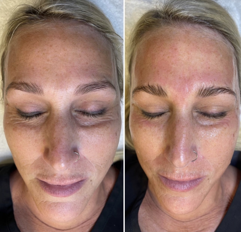 Charlottesville Medical Spa Before and After Skin Treatment