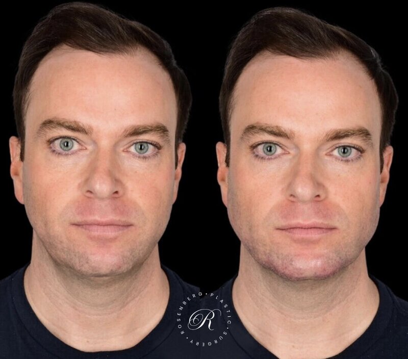 Non-surgical ChinJaw Augmentation RPS Before & After.zip - 38