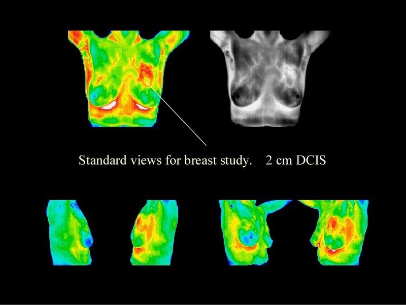 PET, CT Scans, and Thermagraphy for Breast Cancer Imaging