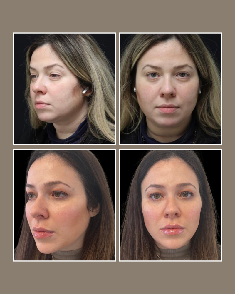 Injectables - Glösense Dermatology and Aesthetics, Miami