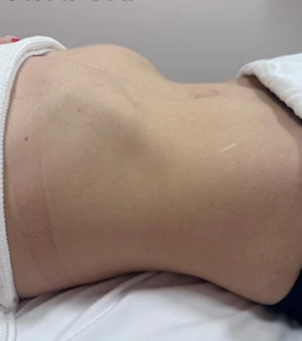 Before a client received a full body sculpting massage