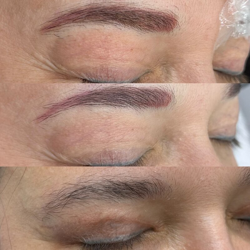 Acid and Laser removal nyc