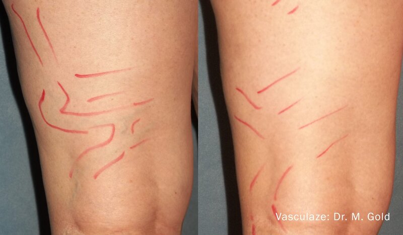 vasculaze-before-after-dr-mgold-preview-1