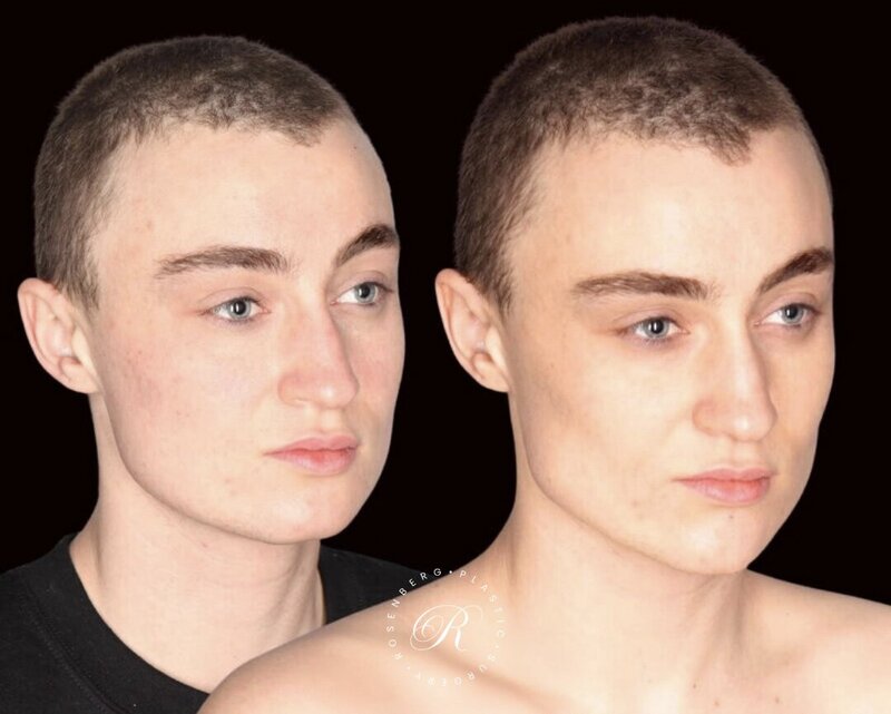Non-surgical ChinJaw Augmentation RPS Before & After.zip - 34