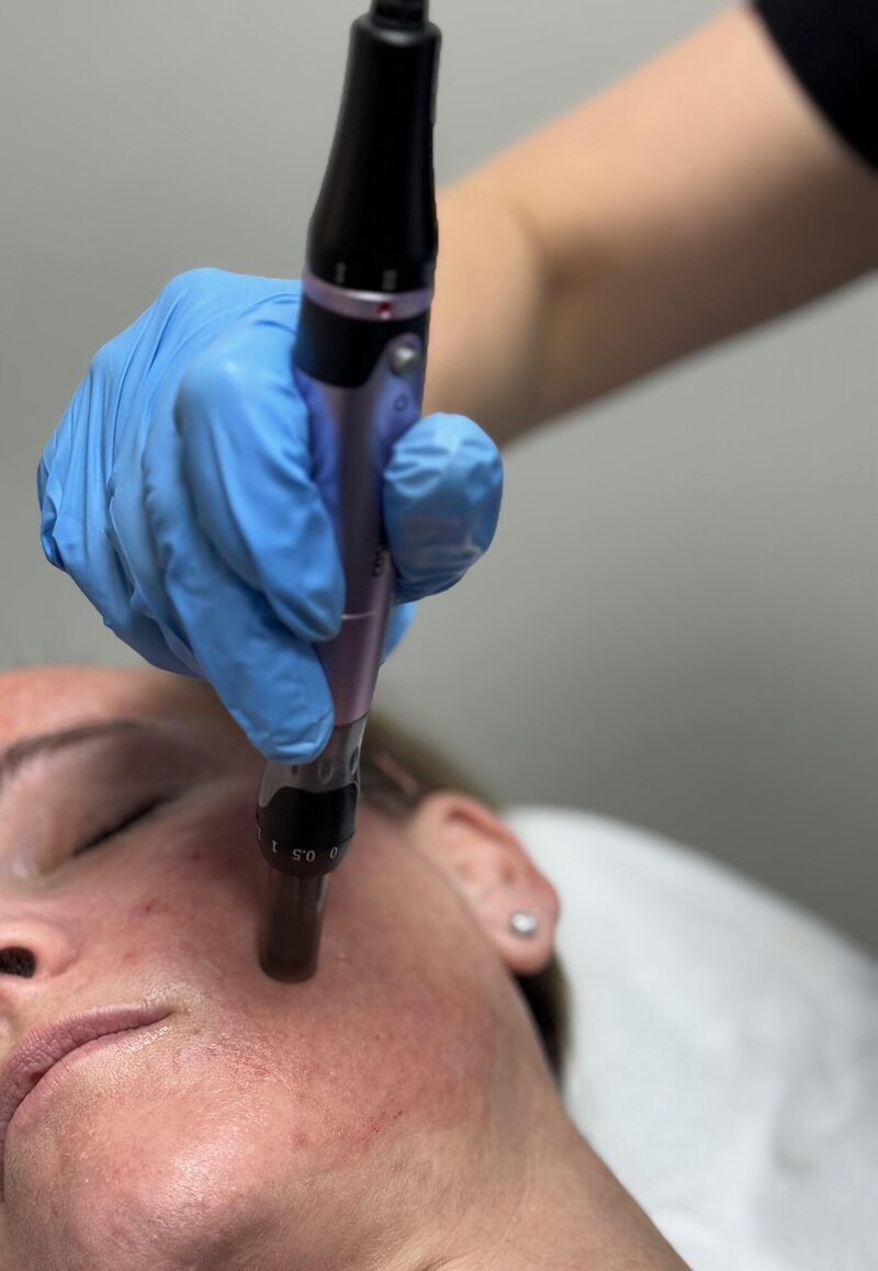Esthetician giving woman a dermaplaning facial