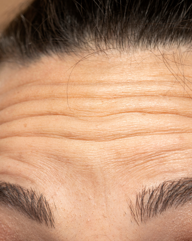 Close-up of forehead lines before treatment.