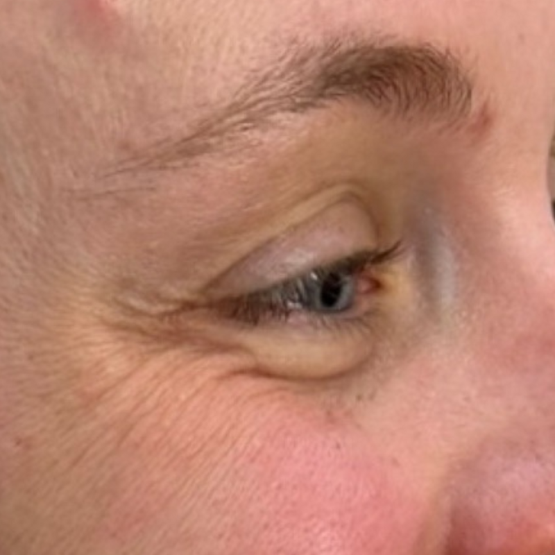 crows feet 1b