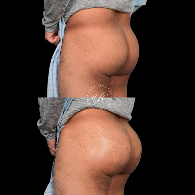 BeverlyBum RPS Before & Afters - 3