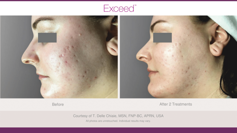 Candela Exceed before and after photo face