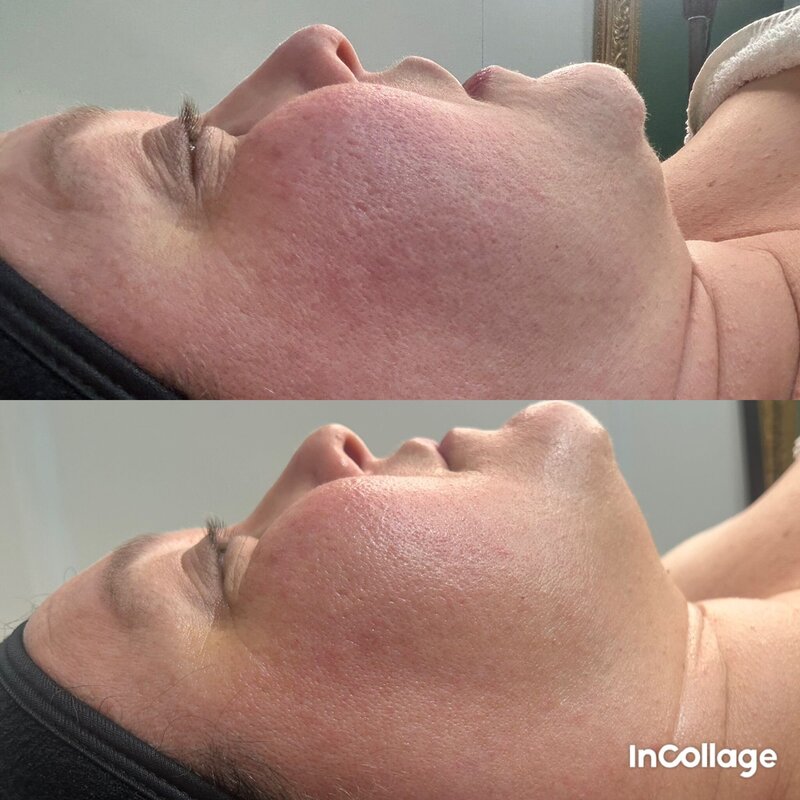 avant après du jet peel