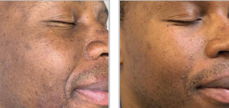 Before and after MOXI laser facial displaying smoother skin with minimized pores and discoloration.
