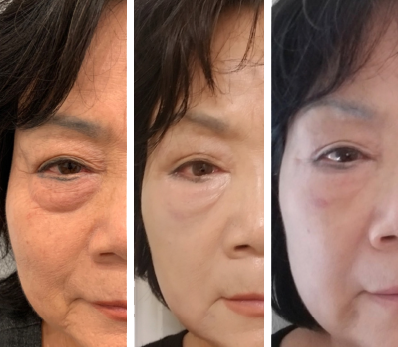Boise Acne care