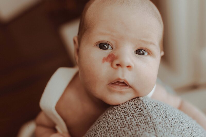 Baby with a birthmark on the cheek looking towards the camera, resting on a textured blanket.