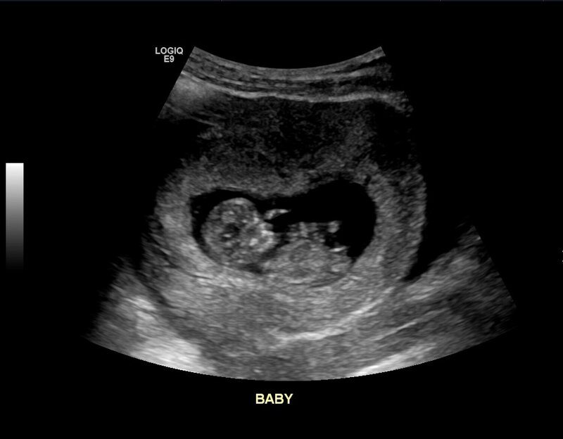 infant ultrasound