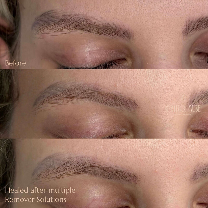 Acid Microblading Removal NYC