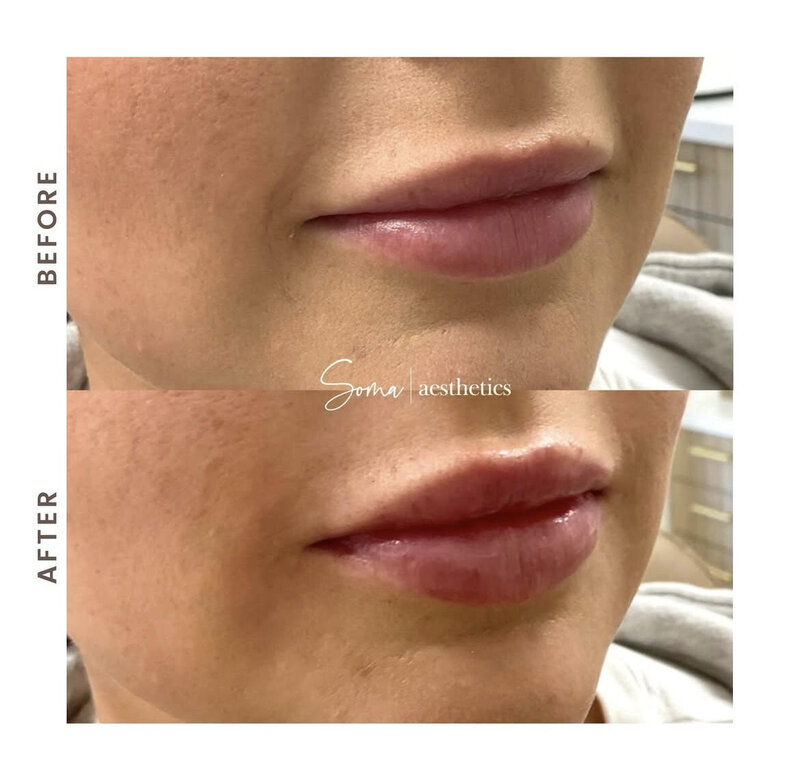 Lip Filler 
