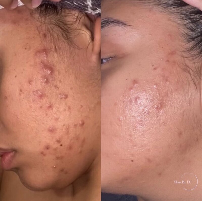 Skincare results from  face reality acne boocamp