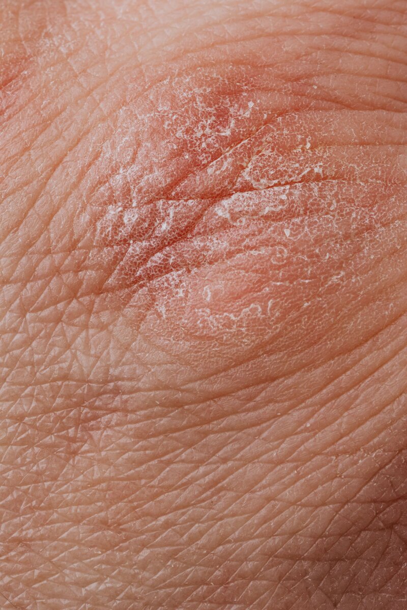 close up of skin patch that is red, irritated, and dry