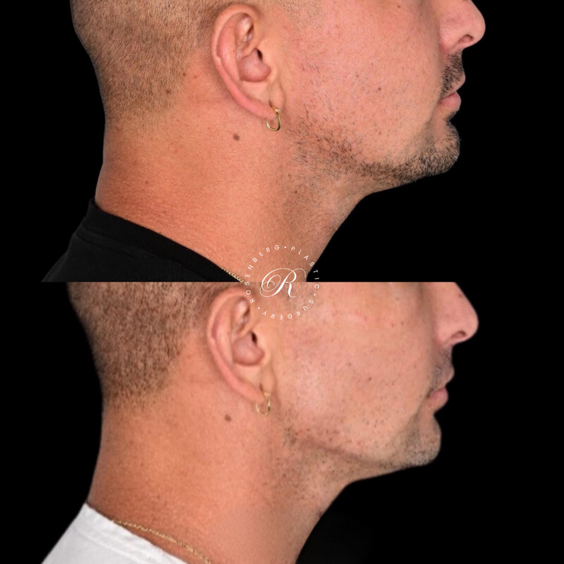 Non-surgical ChinJaw Augmentation RPS Before & After.zip - 50