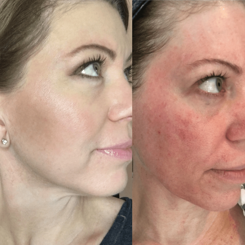 Skin-Pen-microneedling-before-and-after-and-top-left-on-page-RENAME-2