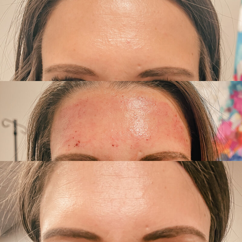 Microneedling in Rockwall TX