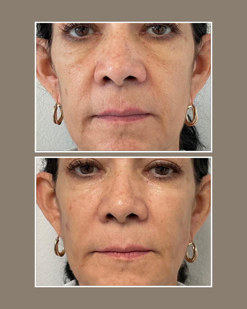 dermal fillers - Injectables - Glösense Dermatology and Aesthetics, Miami