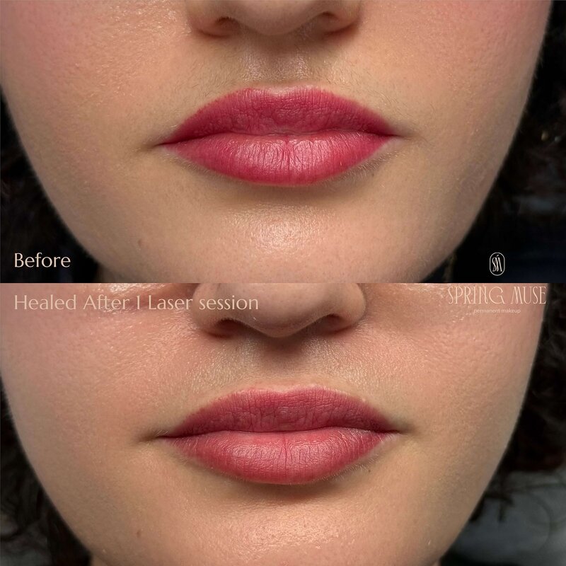 Lip Blush laser removal NYC