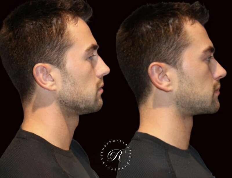 Non-surgical ChinJaw Augmentation RPS Before & After.zip - 37