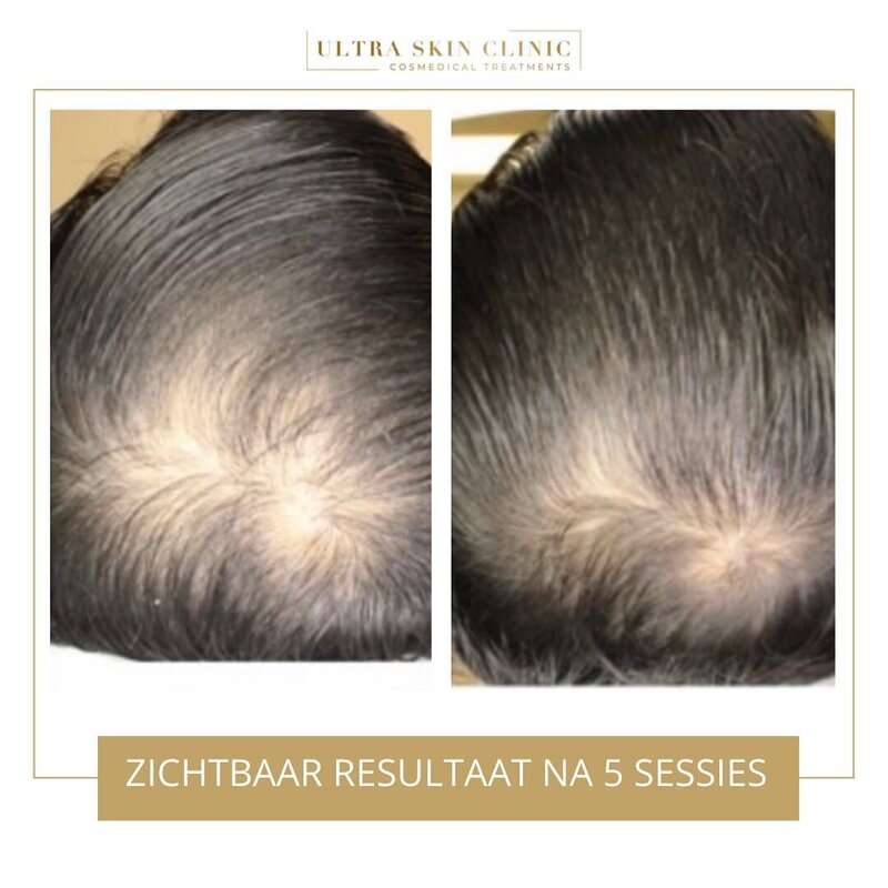 behandeling haarverlies ultra skin clinic