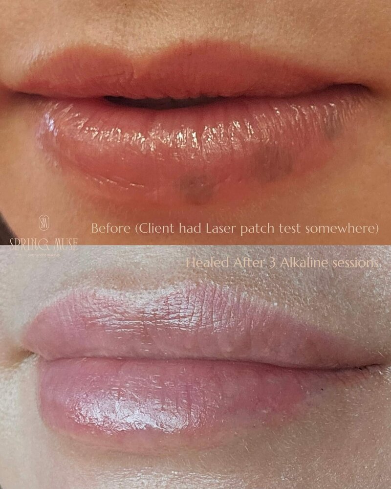 Alkaline Lip Blush Removal NYC
