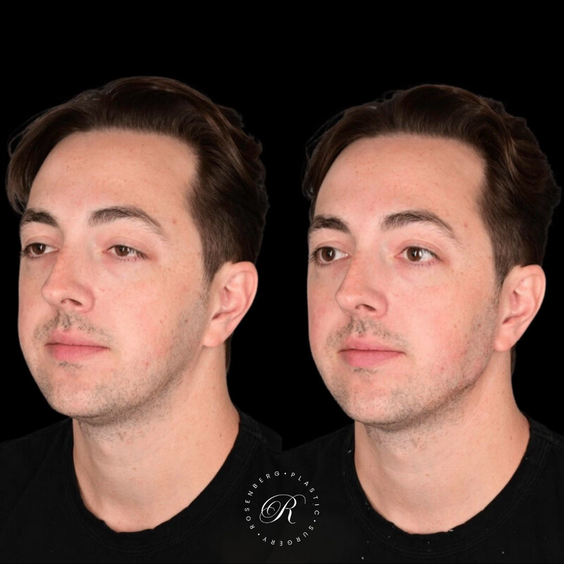 Non-surgical ChinJaw Augmentation RPS Before & After.zip - 28