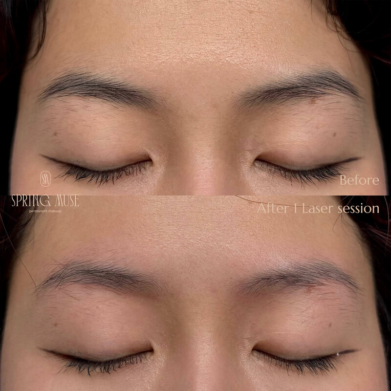 Laser Eyebrows Removal New York