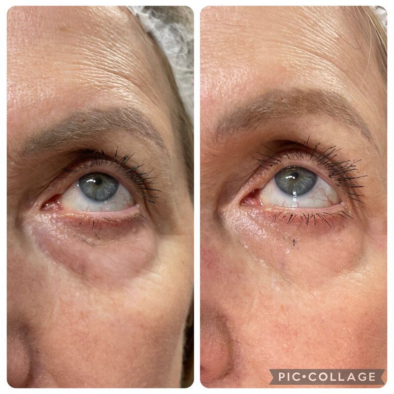 antiwrinkle injections in norwich