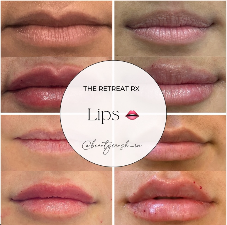 Lippies