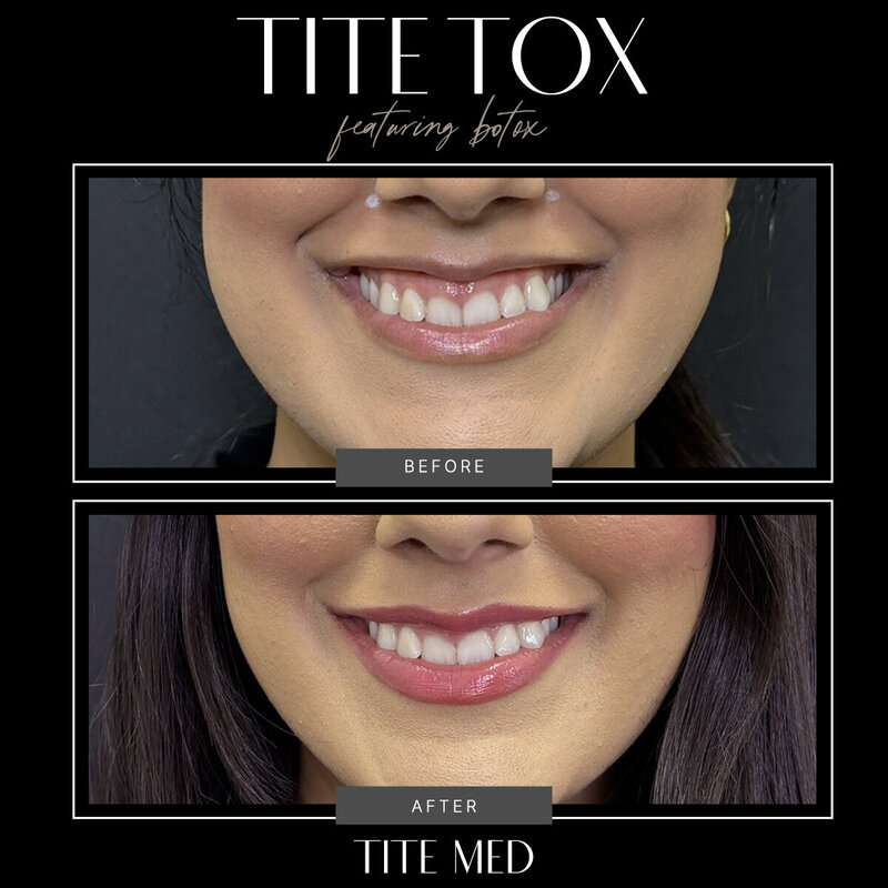 TITE-BEFOREAFTER copy 5