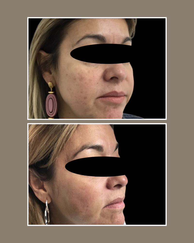 Lasers - Glösense Dermatology and Aesthetics, Miami