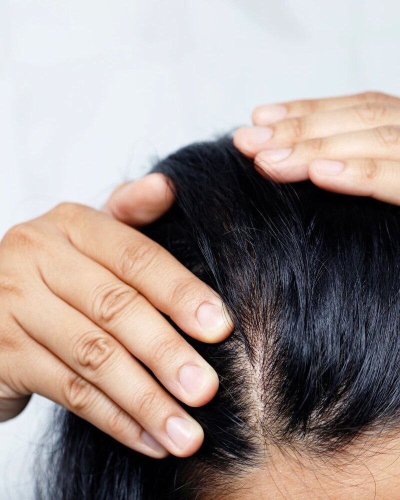 Woman with thinning hair holding hands at hair to show signs of hair shedding.