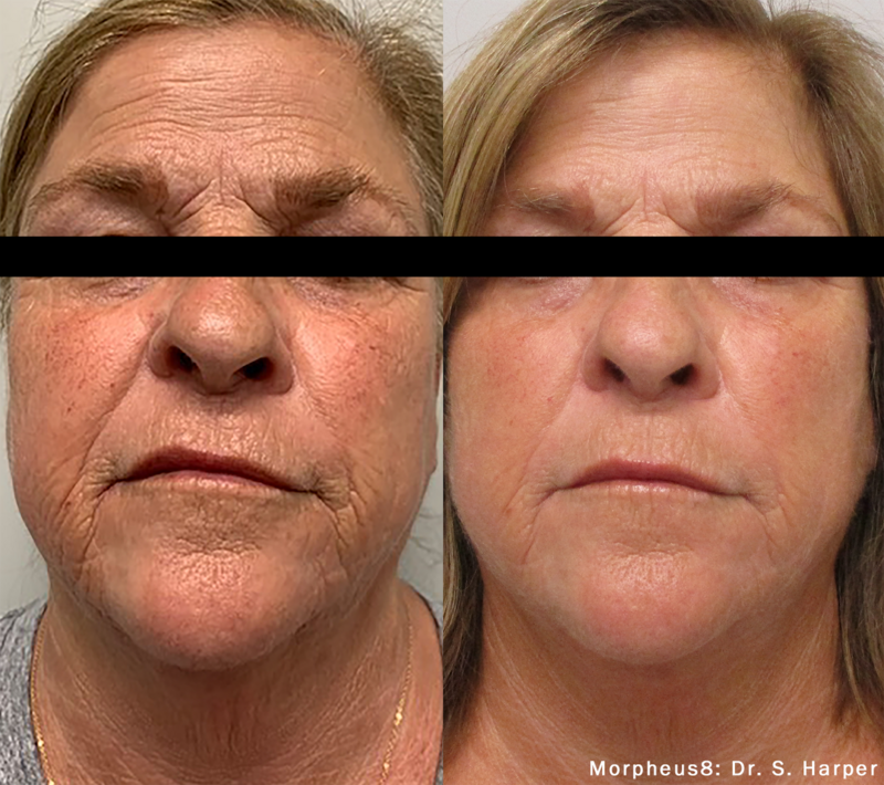 Morpheus8 Before and after of face