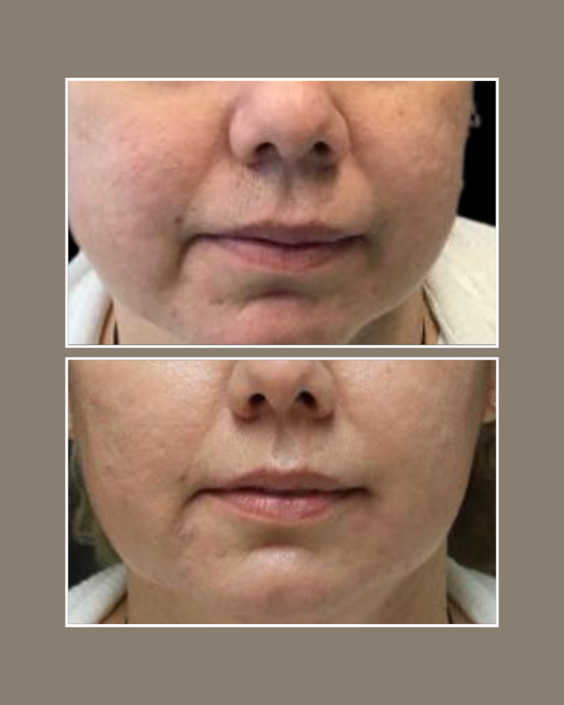 Injectables - Glösense Dermatology and Aesthetics, Miami