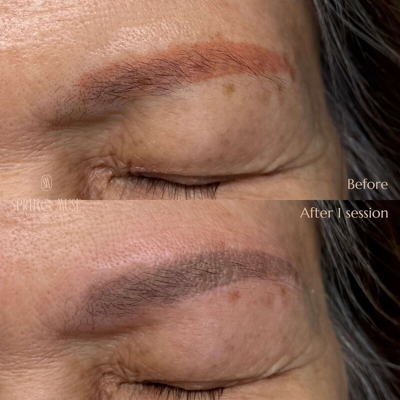 Red brows after PMU? We can remove them. NYC