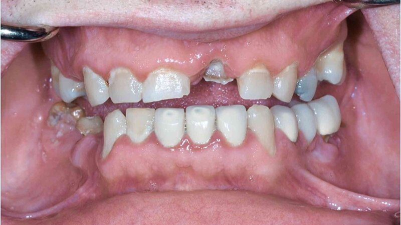 Example 1- a close up shot of the teeth  before getting implants