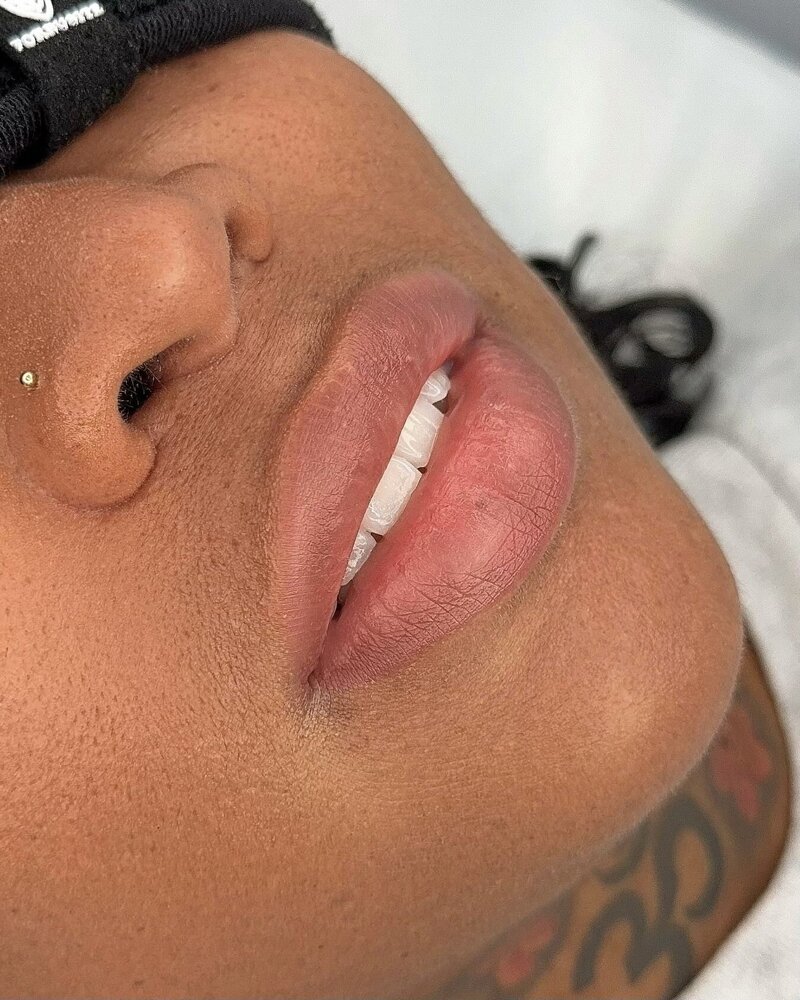 Healed Lip Neutralization after few sessions