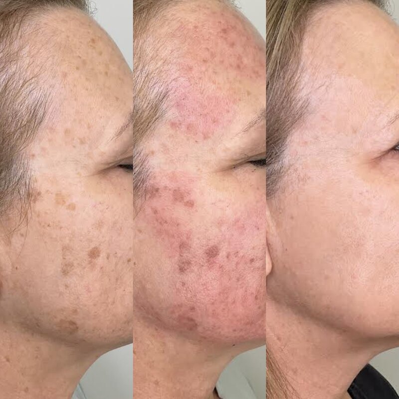 Progress shot of Skin Rejuvenation IPL treatment at luscious skin & Beauty Warrnambool