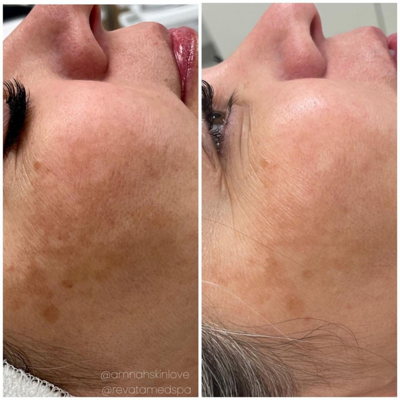 Neo Elite® - Melasma (7)