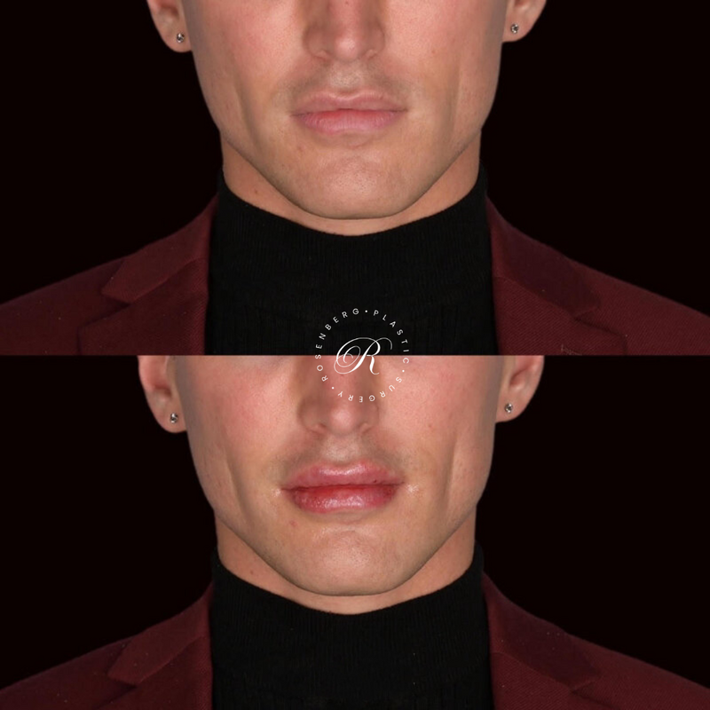 Non-surgical Lip Augmentation RPS Before & Afters.zip - 10